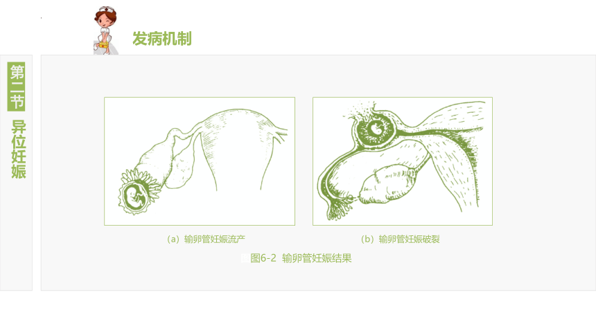 6.2异位妊娠 课件(共19张PPT)-《妇产科护理》同步教学（江苏大学出版社）