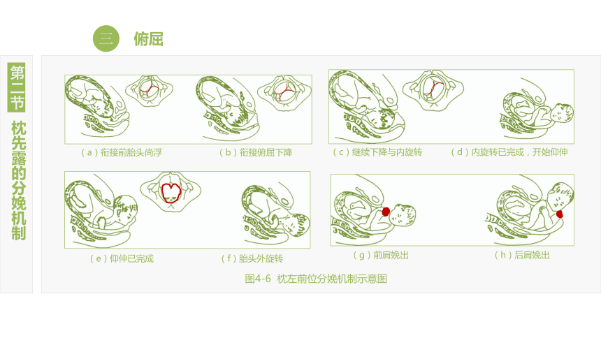 4.2枕先露的分娩机制 课件(共12张PPT)-《妇产科护理》同步教学（江苏大学出版社）
