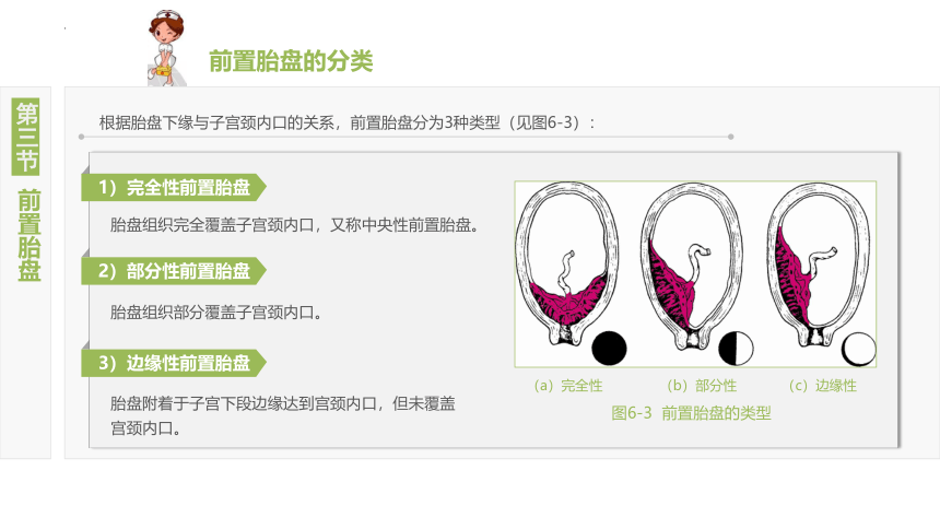 6.3前置胎盘 课件(共16张PPT)-《妇产科护理》同步教学（江苏大学出版社）