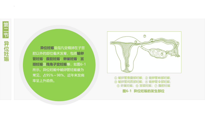 6.2异位妊娠 课件(共19张PPT)-《妇产科护理》同步教学（江苏大学出版社）