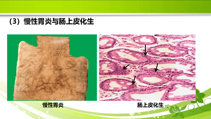 5.6肿瘤的防治 课件(共29张PPT）《病理学》同步教学（人卫版）