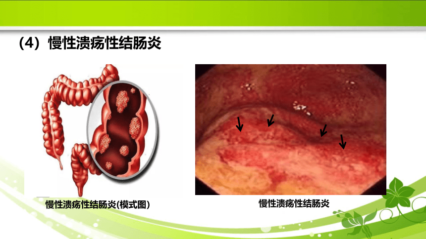 5.6肿瘤的防治 课件(共29张PPT）《病理学》同步教学（人卫版）