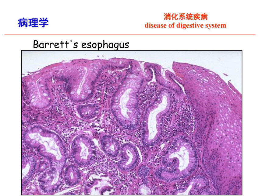第8章 消化系统疾病_1课件(共52张PPT)-《病理学·第4版》同步教学（科学出版社）