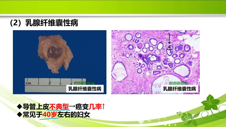 5.6肿瘤的防治 课件(共29张PPT）《病理学》同步教学（人卫版）