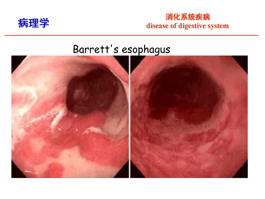 第8章 消化系统疾病_1课件(共52张PPT)-《病理学·第4版》同步教学（科学出版社）