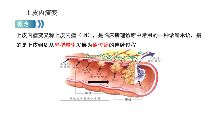 第四章 肿瘤-  上皮内瘤变 课件(共12张PPT)-《病理学基础》同步教学（人卫版）