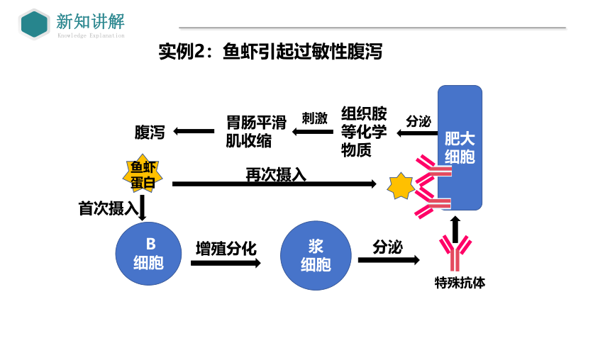 4.3免疫失调课件(共33张PPT3份视频)-人教版（2019）选择性必修1