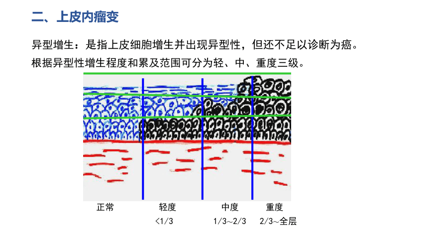 4.5癌前病变、上皮内瘤变  课件(共23张PPT) -《病理学基础》同步教学（人卫版）