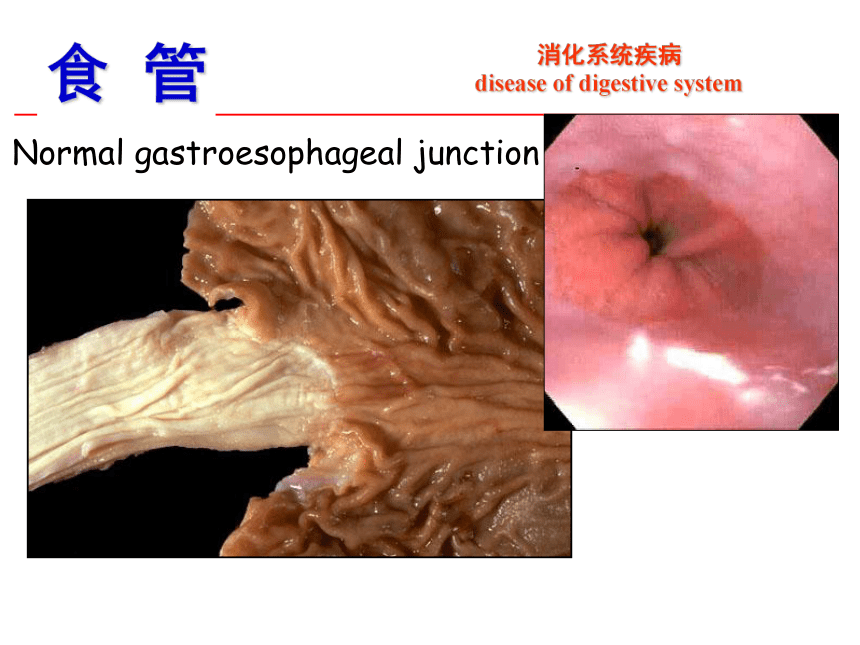 第8章 消化系统疾病_1课件(共52张PPT)-《病理学·第4版》同步教学（科学出版社）