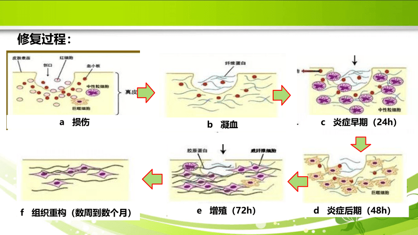 1.3损伤的修复 课件(共31张PPT)《病理学》同步教学（人卫版）