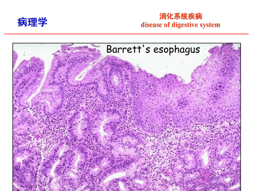 第8章 消化系统疾病_1课件(共52张PPT)-《病理学·第4版》同步教学（科学出版社）