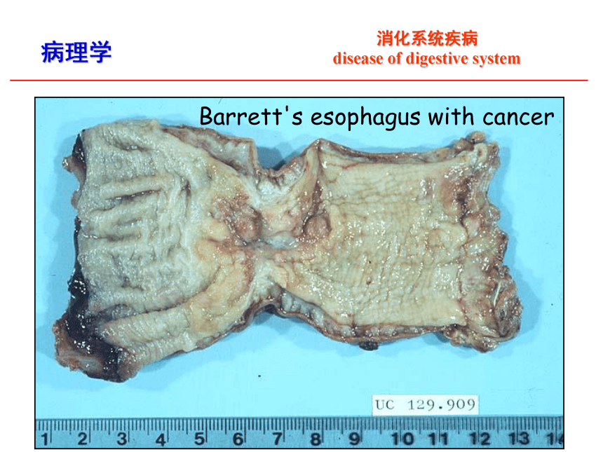 第8章 消化系统疾病_1课件(共52张PPT)-《病理学·第4版》同步教学（科学出版社）