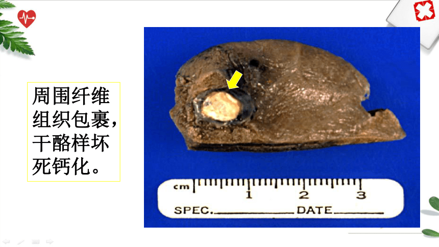 第十章常见传染病 课件(共38张PPT）《病理学》同步教学（人卫版）