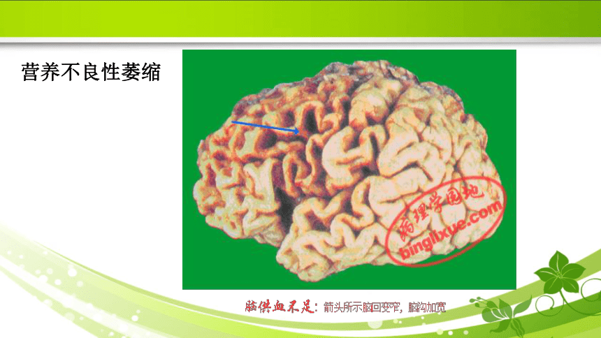 1.1细胞和组织的适应 课件(共21张PPT)《病理学》同步教学（人卫版）