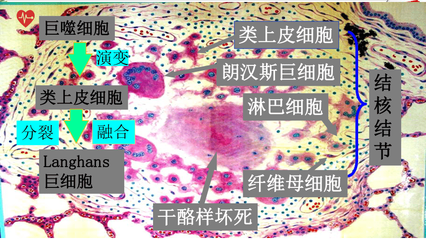 第十章常见传染病 课件(共38张PPT）《病理学》同步教学（人卫版）