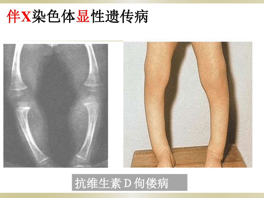 2020-2021学年高一下学期生物人教版必修2  第5章第3节人类遗传病课件（31张ppt）