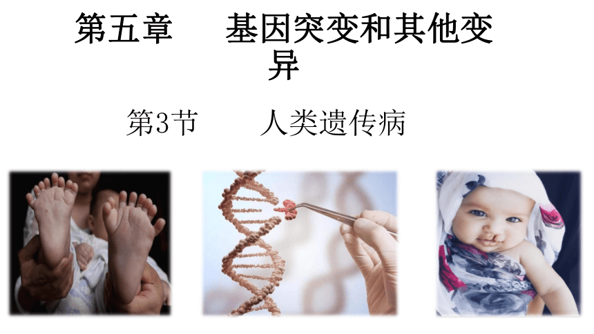 5.3人类遗传病课件(共25张PPT)-人教版（2019）必修2